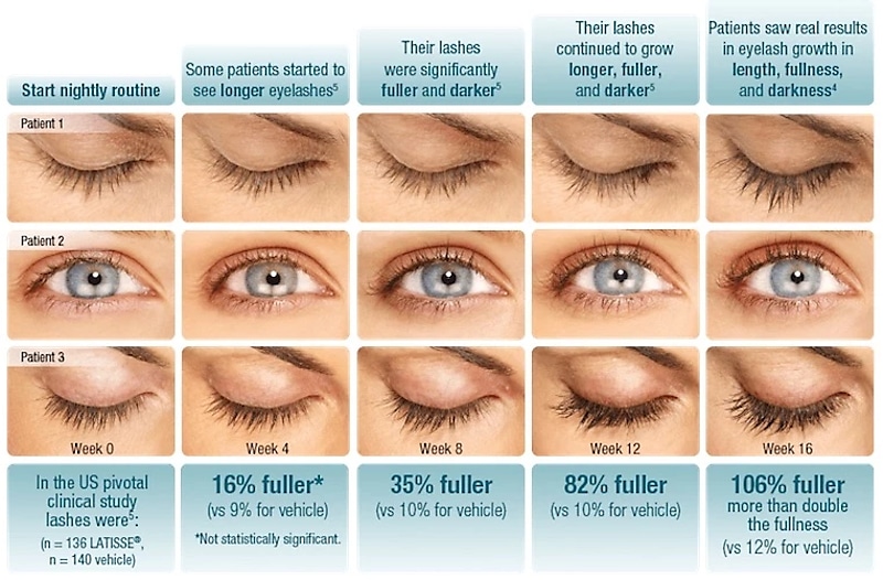 harman eye latisse-16-week-progress-chart