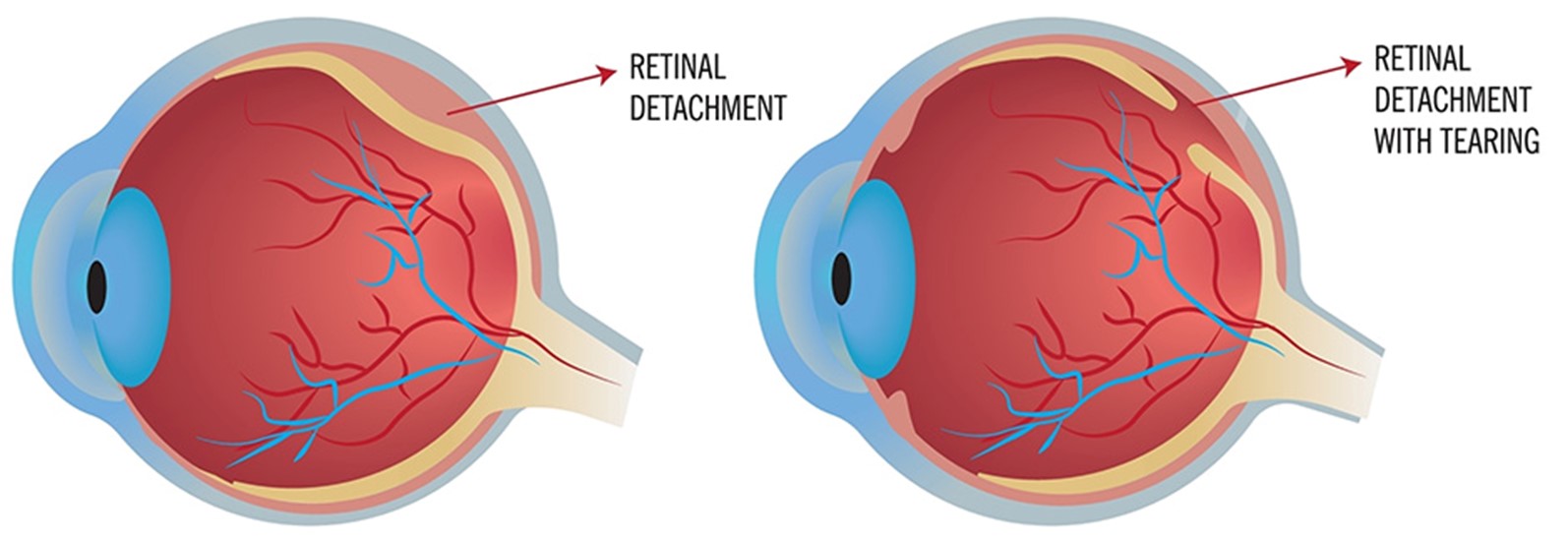 retinal.detachment