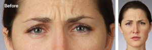 woman's forehead before botox