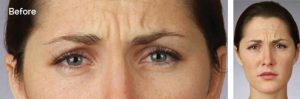 woman's forehead before botox
