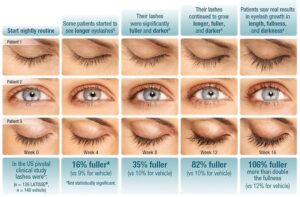harman eye latisse-16-week-progress-chart