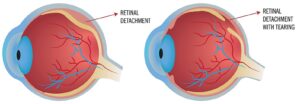 retinal.detachment